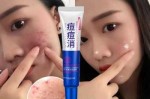 用什么敷脸可以祛痘（什么敷脸可以祛痘印）