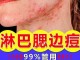 什么去痘好（痘痘怎么去除效果好）