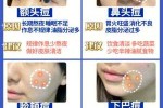 怎么样快速消除痘痘（怎么样快速消除痘痘红肿）