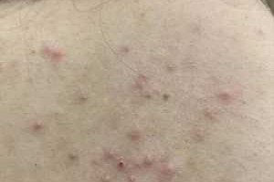 脸上长粉刺怎么治（脸上背部长痘痘，怎么治疗）
