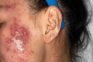 脸上长了很多痘痘，还是发脓的痘痘，可以吃阿莫西林的吗,脸上长痤疮的治疗法