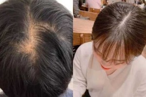头皮是什么颜色（头皮是什么颜色为正常）