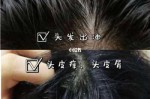 头发两天就油了有啥好办法,头发两天就出油怎么办头皮屑