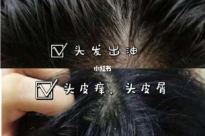 头发两天就油了有啥好办法,头发两天就出油怎么办头皮屑