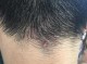 头皮上经常长粉刺，我要做什么来治疗这个症状,头皮上长粉刺怎么回事图片