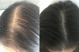 头发越来越少是怎么回事（头发越来越少是怎么回事女性）