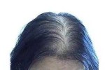 女人脂溢性脱发怎么治（女人脂溢性脱发怎么治疗）