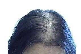 女人脂溢性脱发怎么治（女人脂溢性脱发怎么治疗）