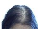 女人脂溢性脱发怎么治（女人脂溢性脱发怎么治疗）