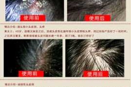 治头屑的最好方法是什么（治头屑的最好方法是什么）