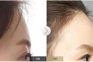 什么叫额头高,突额头是什么原因造成的
