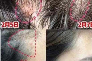头皮总是出油厉害是怎么回事?头皮出油怎么办,头皮爱出油是什么原因引起的