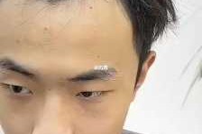 额头前面的头发老是梳不下去，都是翘起来的，很难看，怎么弄好它,头发前面稀少怎么办除了植发