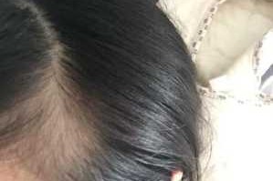 前面的头发稀少怎么办（9个月宝宝头顶头发稀少怎么办给宝宝吃什么补）