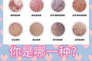 什么法痘（治疗什么样痘痘）