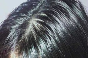 为什么头发会油,头发为什么这么油腻呢?