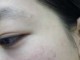 痘痘留下的黑印怎么去除像痣一样,黑痘怎么去除掉