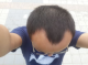两鬓脱发是什么原因（两鬓脱发是什么原因引起的）