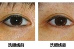 眼角纹怎么去除,怎么样去除眼角纹眼线