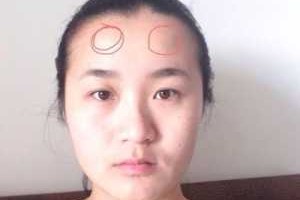 额头太凸怎么办（额头太凸怎么办图片）
