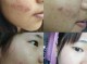 脸上的痤疮 怎么去除（脸上的痤疮 怎么去除）