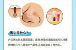 怎么缩毛孔去黑头（如何去黑头和缩小毛孔）