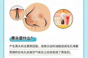 怎么缩毛孔去黑头（如何去黑头和缩小毛孔）