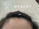 碎头发多是什么原因（碎头发太多怎么办）