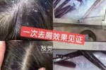 头发痒有头皮屑怎么办（头发痒有头皮屑怎么办小窍门）
