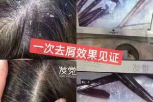 头发痒有头皮屑怎么办（头发痒有头皮屑怎么办小窍门）