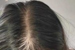 脱发严重是因为什么（女人脱发严重是怎么回事）