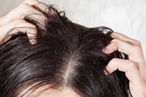 头发碎发多怎么回事,为什么碎头发很多头皮屑