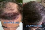 年轻人头顶脱发怎么办（年轻人脱发怎么治疗最有效果呢）