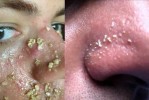 鼻子上长粉刺怎么办（鼻子有粉刺怎么办）