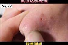 鼻头黑头怎么去除,鼻头很多黑头怎么办图片