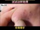 鼻头黑头怎么去除,鼻头很多黑头怎么办图片