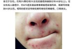 下巴长痘什么原因,下巴为什么长痘痘红肿硬硬的还疼