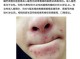 下巴长痘什么原因,下巴为什么长痘痘红肿硬硬的还疼