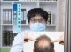 头发油脱发怎么办（头皮油脱发怎么治疗）