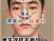 男怎么去痘（男怎么去痘印）