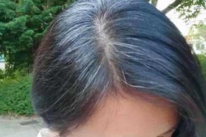 我是青少年白发,可是结婚生孩子后,为什么没有白发了呢,为什么会生白发的原因
