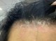 头皮痒脱发是怎么回事,头皮痒掉发怎么治疗好