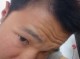 头发细软少是什么原因（额头两侧头发细而且少，中间头发厚两侧薄）