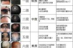 毛多和毛少的人有什么区别,男人毛发稀少是什么原因