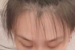额头碎发多是什么原因（女孩子额头碎发多怎么办）
