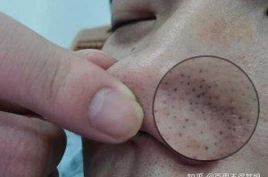 鼻子上有黑头,鼻头有黑头是什么原因造成的