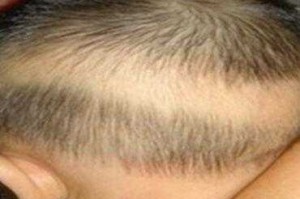 小学生适合什么发型（孩子后脑勺有一块没有头发是什么情况）