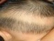 小学生适合什么发型（孩子后脑勺有一块没有头发是什么情况）