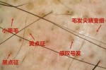 脱发断发是什么原因（脱发断发是什么原因引起的）