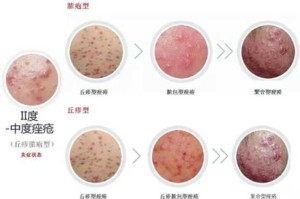 长粉刺怎么处理（长粉刺怎么处理比较好）